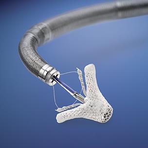 Mitraclip FDA approved for treatment of degenerative mitral valve disease in those at high surgical risk High risk: >6% mirtal valve