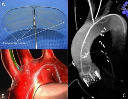 Protection of cerebral events during TAVR