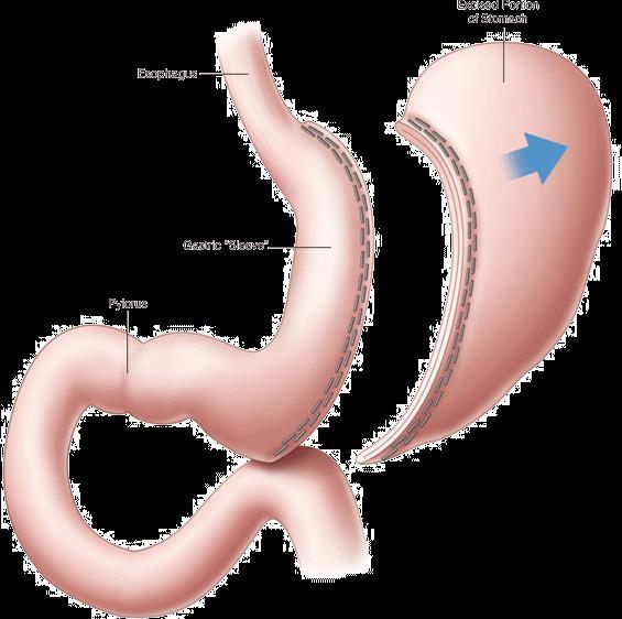 Sleeve Gastrectomy Disadvantages Staple line leak (1-2%) Staple line stricture (0.