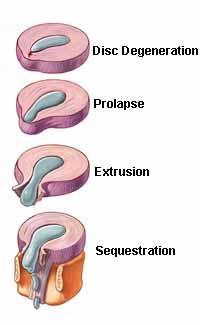 Nomenclature and Classification of Disc Pathology Herniations may have the following morphology and are often