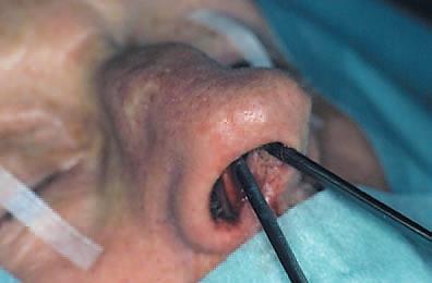 septum These manoeuvers help to straighten the cartilaginous dorsum of the nose, as can be seen in Figure 19b.
