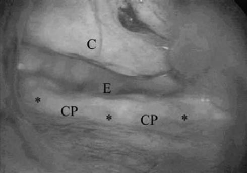 Dysfunction of the Upper Esophageal Sphincter? No RCT From: Chiu MJ et al.