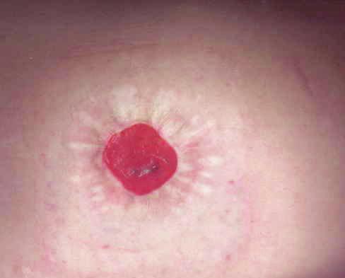 30 Stoma Retraction Stoma retraction means the stoma is at or below the skin level. It looks like it is shrinking.