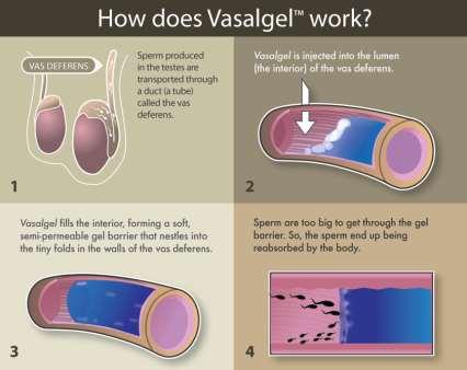 6. Other Reversible Inhibition of Sperm Under Guidance (RISUG) or simply lead to current male BC Vasalgel - Reversible and non-hormonal - QUICK (10 15 min procedure in office) - Cheap.