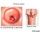 (Gardasil) Cervical cancer stages Cervical polyps Vaginal warts Cervical warts Throat cancer? Penile warts Viral STDs 3.
