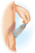 5. Barrier Methods Male condom Female condom Only form of BC that protects genitals against STDs Dental Dam