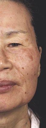 differentiated from the rest of the skin, FLT is selectively absorbed by water, which is present in all
