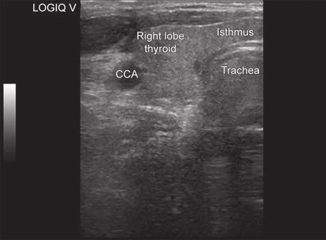 Sagar Tyagi et al Fig. 2: Transverse scan of thyroid gland with normal thyroid parenchyma Fig. 3: Ultrasound evaluation of right lobe of thyroid gland to estimate thyroid volume Fig.