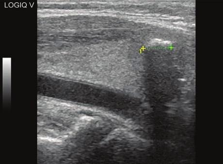 19: Longitudinal scan of a lesion with egg shell calcification and shadowing