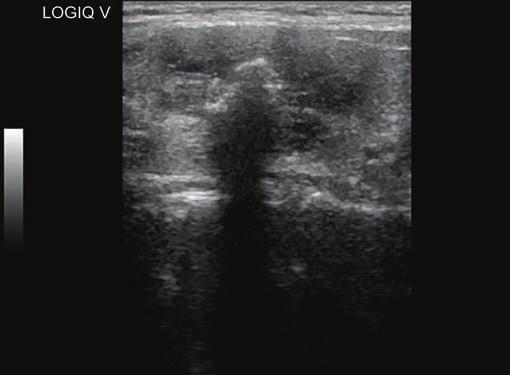 IJAIMS Radiological Evaluation of Thyroid Diseases using Gray Scale and Color Doppler