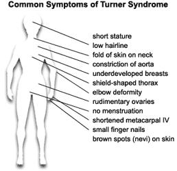 Turner Syndrome Also called XO, because people with Turner s have only 1 X chromosome: 45, X. No Y means Turner s people are female.