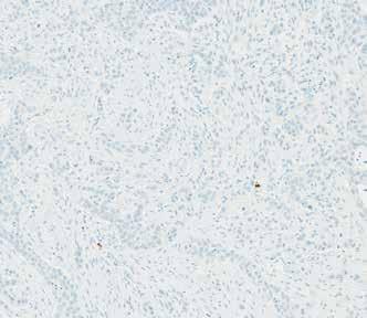 urothelial carcinoma tissue, 10x % IC Staining is 5 % and < 10 % % IC Staining