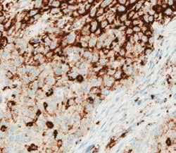 association with tumor cell staining.
