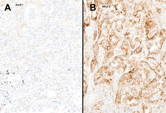 Images Showing Examples of the Expected PD-L1 Expression and Sub-Optimal Demonstration in the UK Neqas Samples Image 7: Optimal staining of the NEQAS tumour