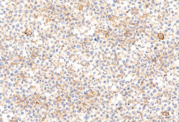 Image 10A: Optimal staining of the NEQAS strongly positive cell line (Core A) using the Ventana SP142 assay in 80-100% of tumour cells.