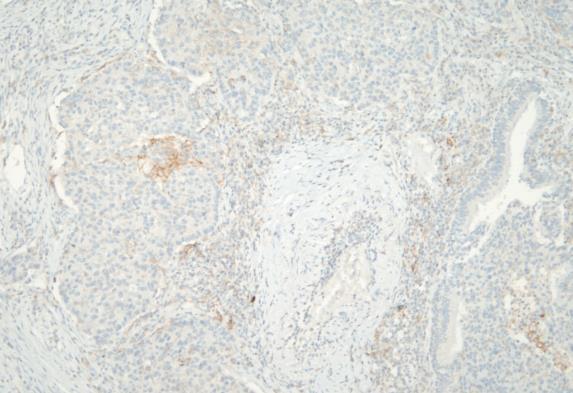Occasional membrane staining may lead to a false-positive diagnosis. Clone: CST E1L3N. Methods not supplied.