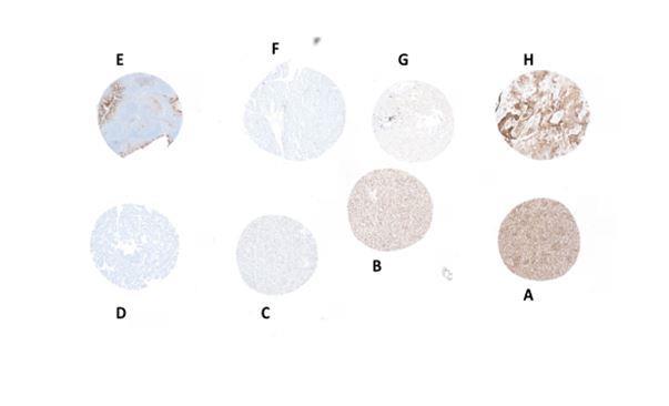 Figure 1: Example of PD-L1 expression for Block 1 stained using Dako (IHC) 22C3 pharmdx: A: Cell line (80-100%TPS); B: Cell line (50-79% TPS); C: Cell line (1-4% TPS); D: Cell line (0% TPS); E: