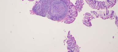 Mantle-cell lymphoma Follicular