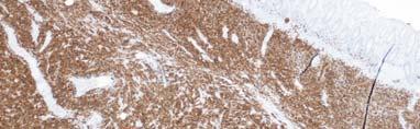Diffuse Large B-cell Lymphoma CD20 Colon Cancer Molecular Studies