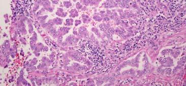 Lung Squamous Cell Carcinoma Makes up