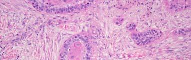Squamous Cell Carcinoma Squamous Cell Carcinoma Lung Small Cell