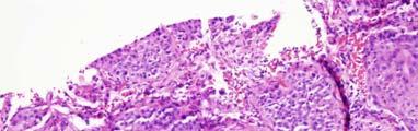 Lung Cancer Immunohistochemistry Lung adenocarcinoma: CK7: Positive (membrane) CK20: Negative TTF-1: Positive (nucleus) Napsin-A: Positive (cytoplasm)