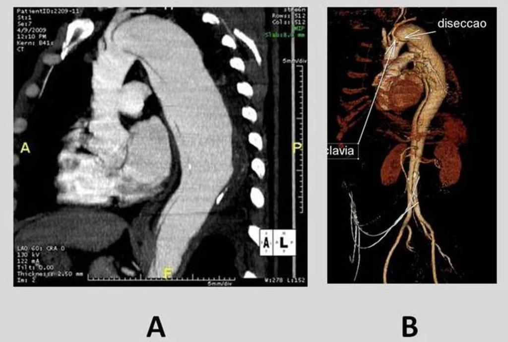 Fig. 1: Contrast enhanced CT sagittal MPR image (A) and color-coded 3D volume rendered image