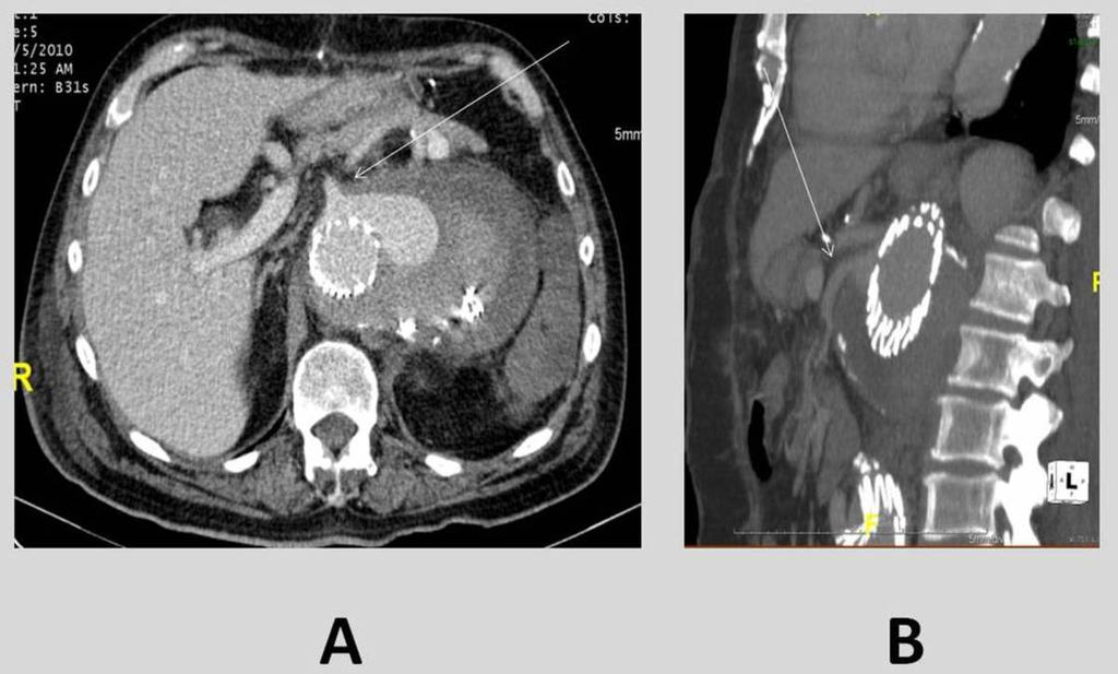 Fig. 5: Axial (A) and sagittal MPR (B) images of helical CT scan show endoleak