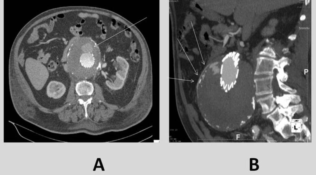 Fig. 8: Axial (A) and sagittal MPR (B) images of contrast enhanced helical CT show