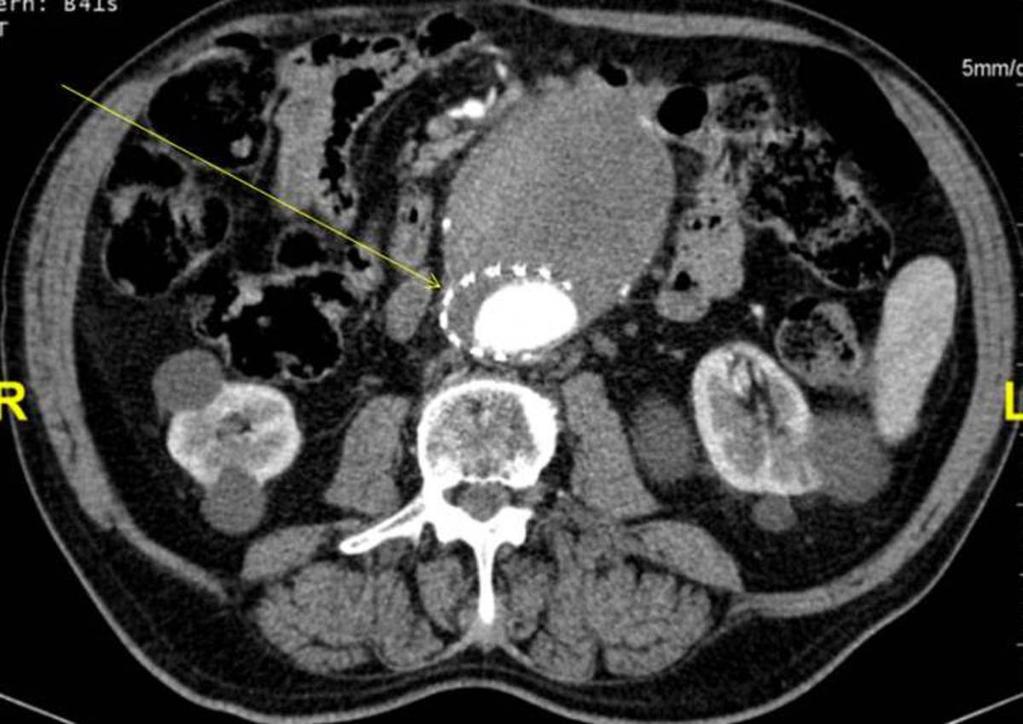 Fig. 11: Axial contrast enhanced CT image