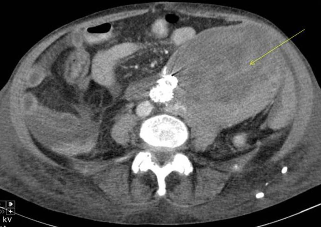 Fig. 14: Hematoma following endografting of an abdominal aortic aneurysm.