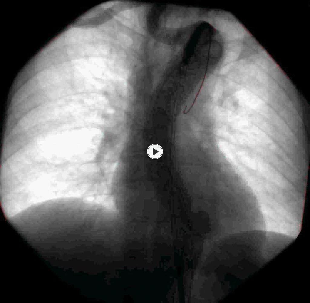 Fig. 2: Endovascular procedure: image from digital subtraction