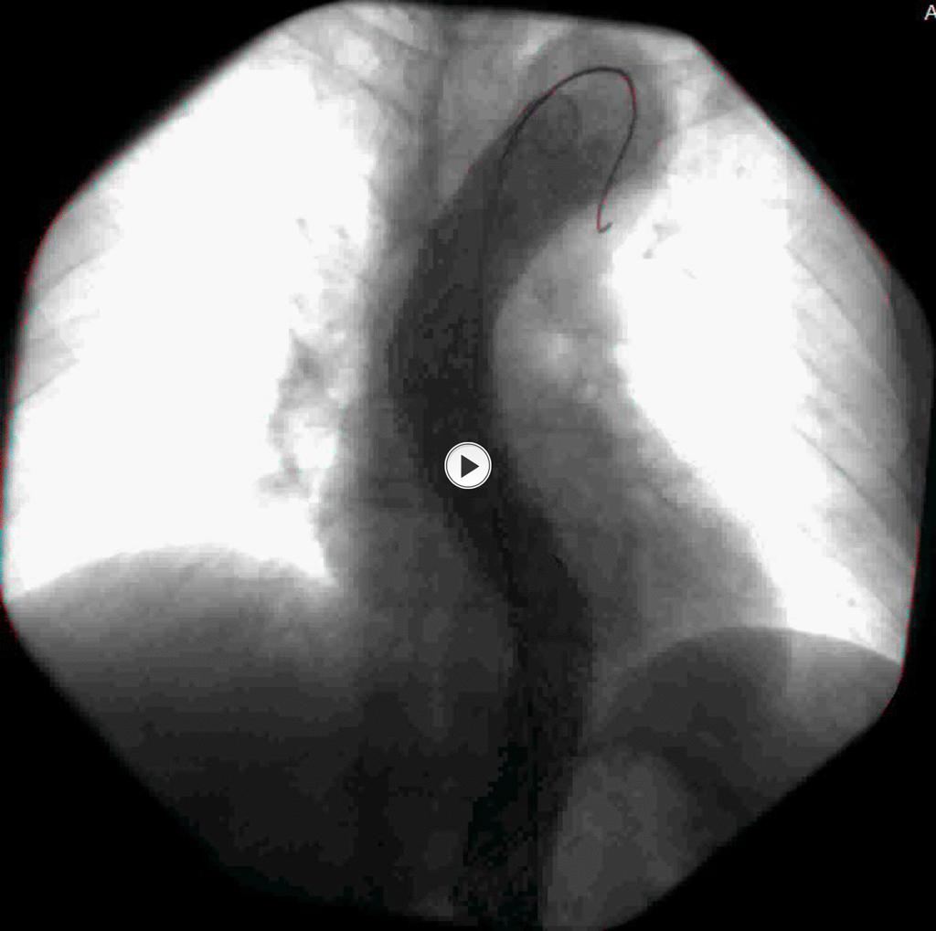 Fig. 3: Post-procedure digital subtraction angiography