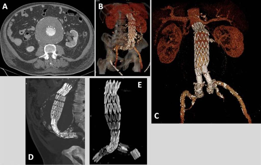 Fig. 4: Contrast enhanced helical CT, axial image (A), color-coded 3D volume-rendered (B, C), sagittal