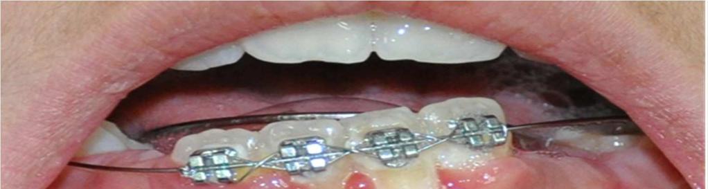 Figure 2,fixed orthodontic treatment and the resulted plaque of a student suffering from gingival recession Figure 3, a sever inflammation with bleeding observed in a student suffering from gingival