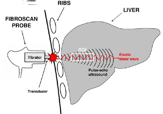 Transient Elastography Ultrasound-based measurement of liver stiffness Transducer probe mounted on axis of a vibrator Vibrator induces an elastic shear wave that propagates through underlying tissue
