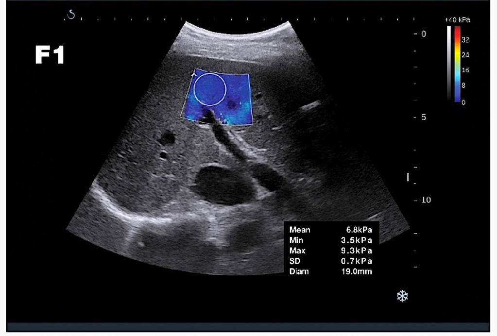 Shearwave Elastography allows Ultrasound and Assessment of Fibrosis to be performed Simultaneously F1: Patient with F1