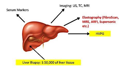 Summary Non Invasive Evaluation of Liver Tissue Fibrosis (Staging) APRI Fib-4 Fibrosure Plat < 15K CT, MRI Consider hepatic vein