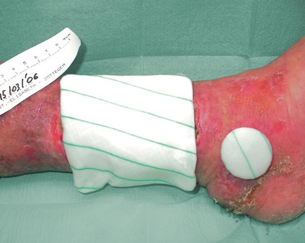 ulcer on the back, and decubitus ulcer on the buttocks. Venous leg ulcer A therapeutic concept implemented in this indication was the application of TenderWet together with a compression bandage.