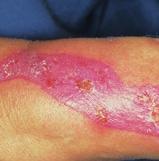 Debridement / cleansing To bring a chronic wound to healing, the initial causes should first be considered and then the wound should be freed as fast as possible from necrosis and coatings which