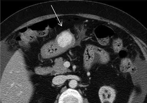Biphasic contrast-enhanced CT scan shows a well-defined tumor