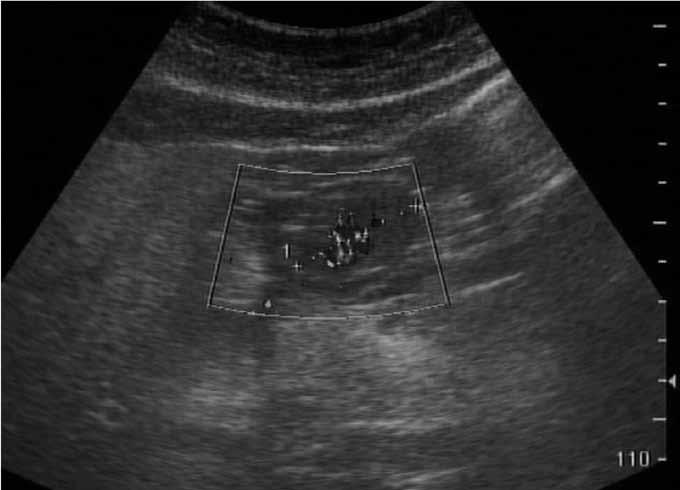 Figure 3 Figure 3. Abdominal sonogram showed a submucosal hyper vascular tumor in the antral wall of the stomach.