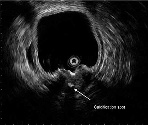 Figure 4 Figure 4. Endosonographic findings. a. It shows a 3 2.