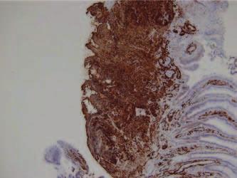 On immunohistochemistry, tumor cells were positive for smooth muscle actin-ab reaction (Immunohistochemical stain, 100).