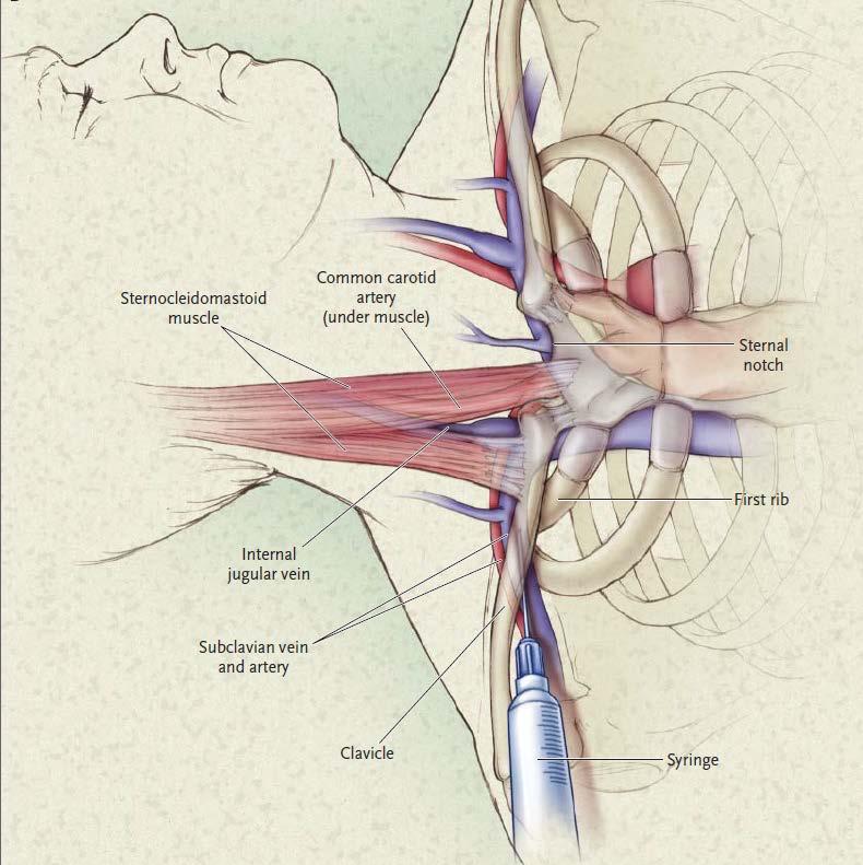 SC vein Landmarks: crosses under clavicle just medial to