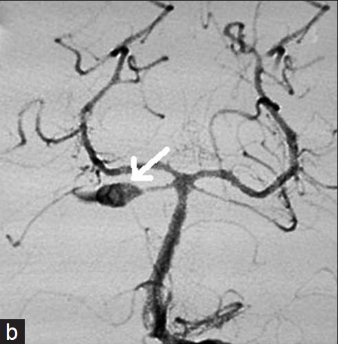Fusiform Aneurysm 3-13% of intracranial aneurysms Most common in