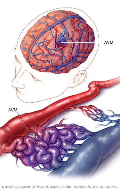 AVM Pathology Shunting of blood from high pressure artery to low pressure venous system Mortality