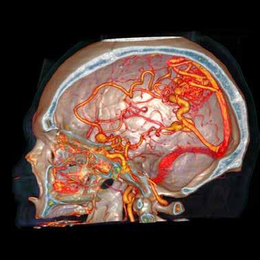Cerebral AVM Hemorrhage Substantial health impact if occurs during pregnancy During Pregnancy Maternal Mortality 28% Fetal Death 14% Miscarriage at early pregnancy Fukuda K,