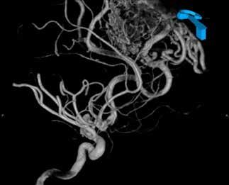 Inflow evaluation Resolution CT Angiography