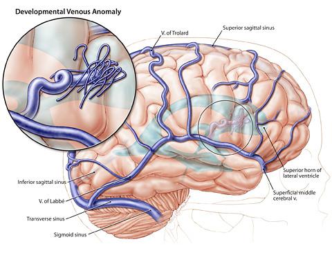 Developmental Venous Anomaly Vestigial draining vein from the cortex Dural sinus Deep ependymal